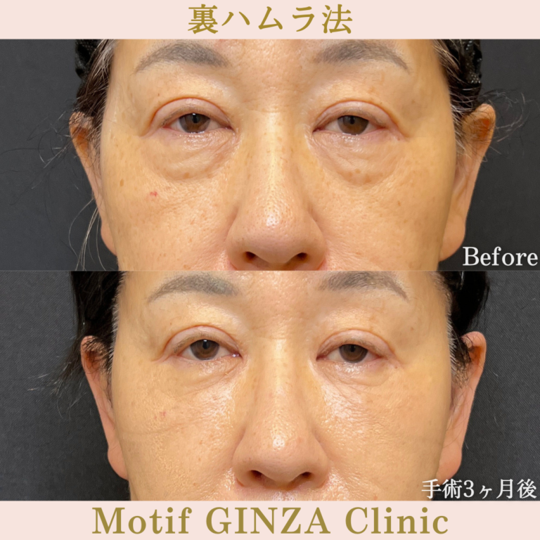 裏ハムラ法(手術2年後)の写真3