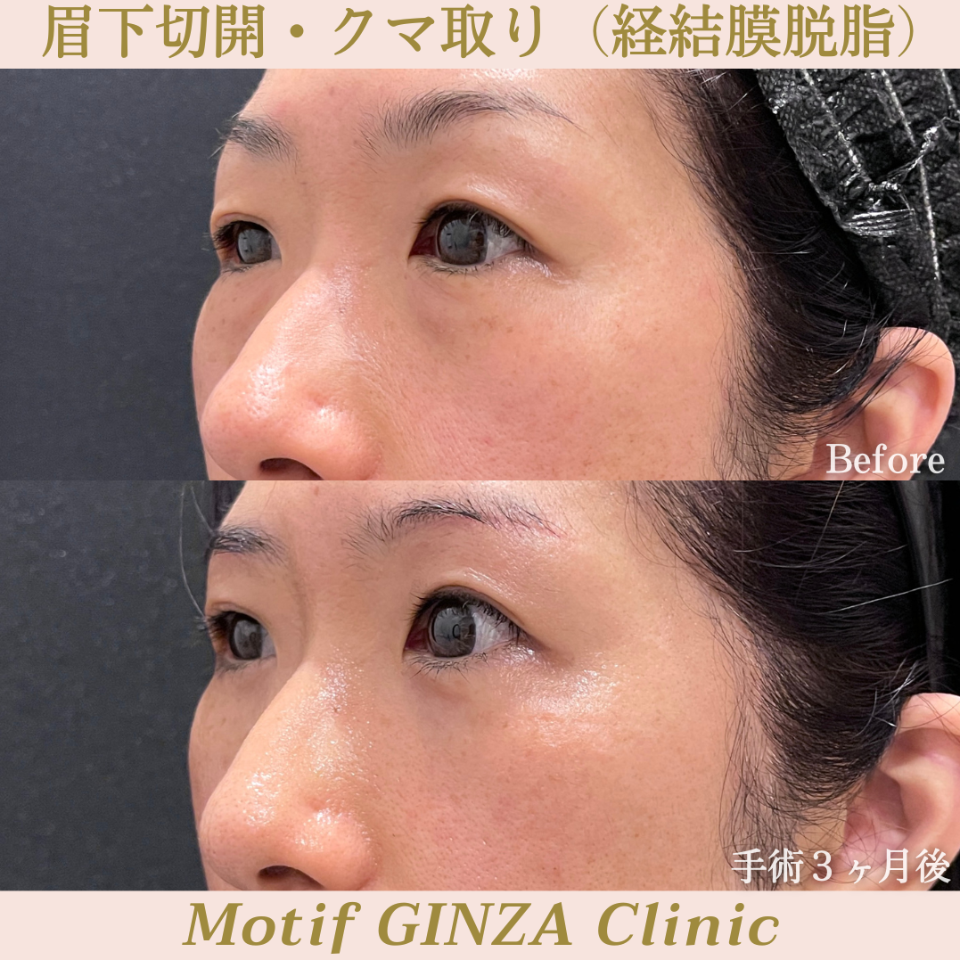 眉下切開・経結膜脱脂(手術3ヶ月)の写真2