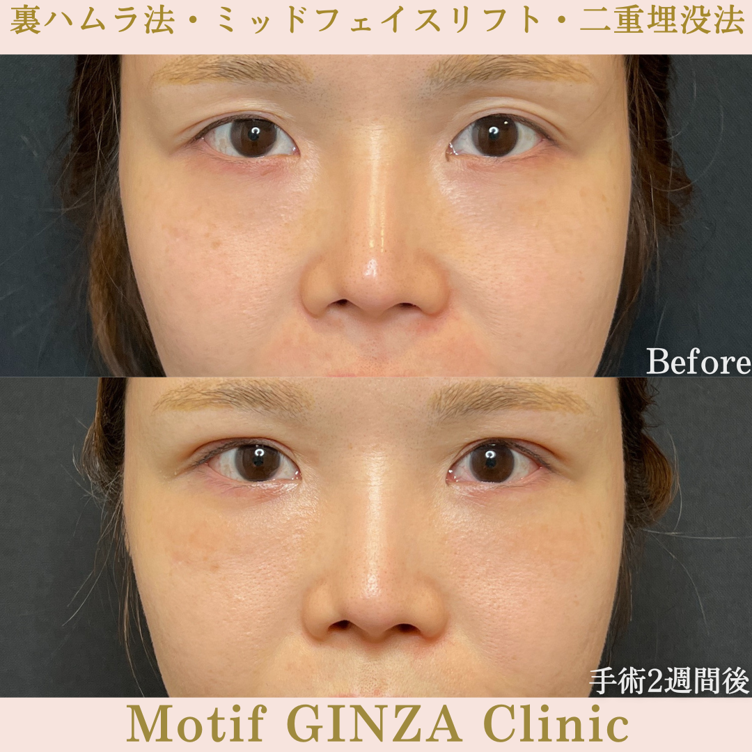 裏ハムラ法・ミッドフェイスリフト・二重埋没法（手術３か月）の写真5