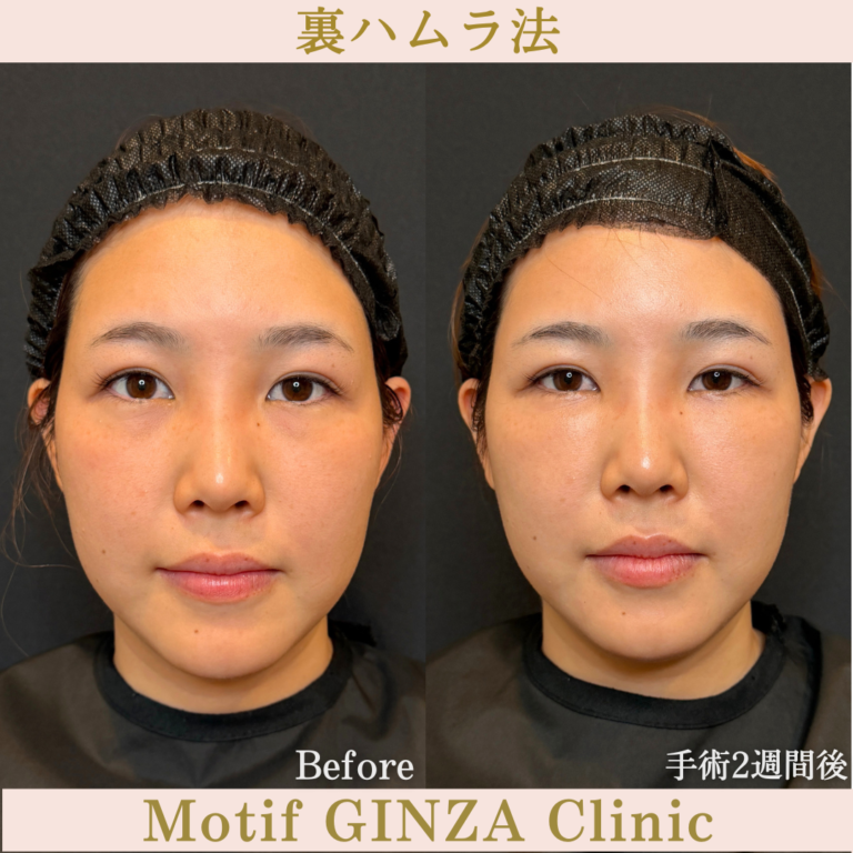 裏ハムラ法(手術1か月)の写真2