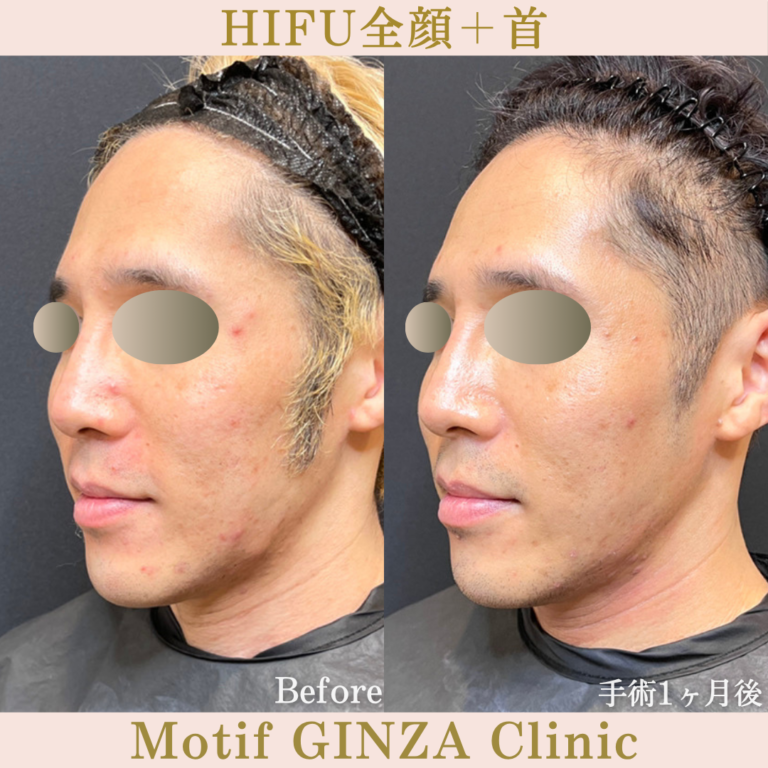 HIFU全顔＋首（手術１ヶ月）の写真2