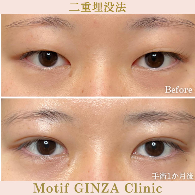 二重埋没法法（手術１か月）