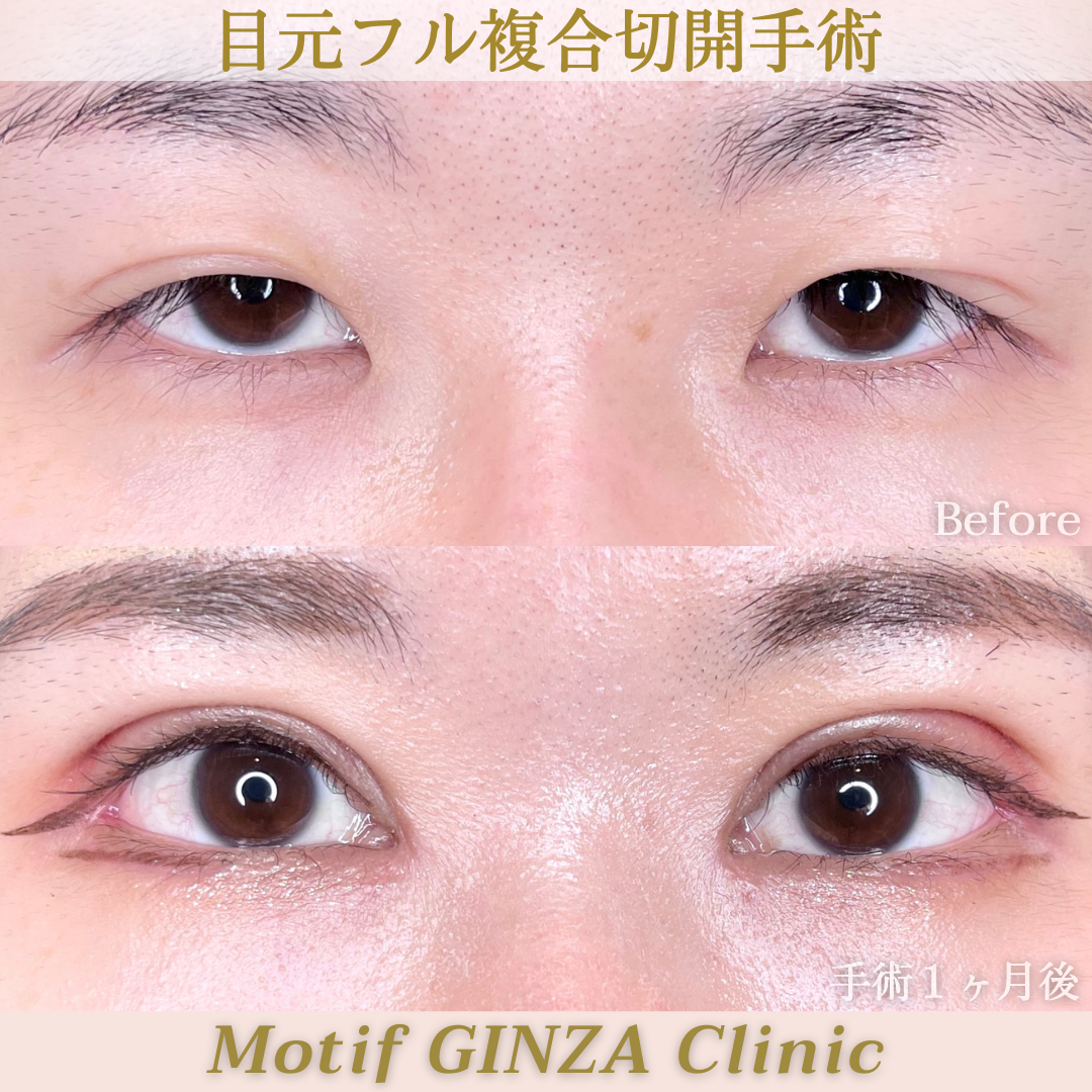 目元複合切開(手術3ヶ月)の写真3