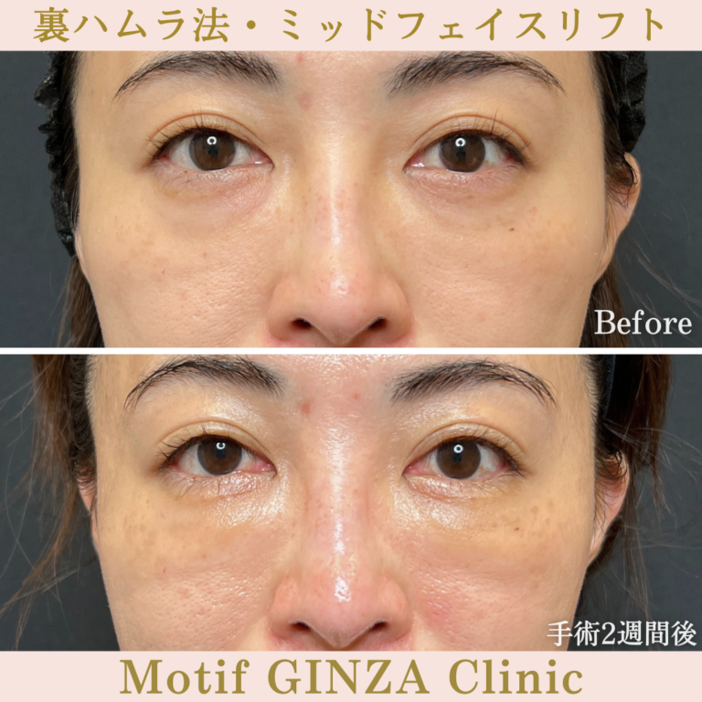 裏ハムラ法・ミッドフェイスリフト（手術３か月）の写真5