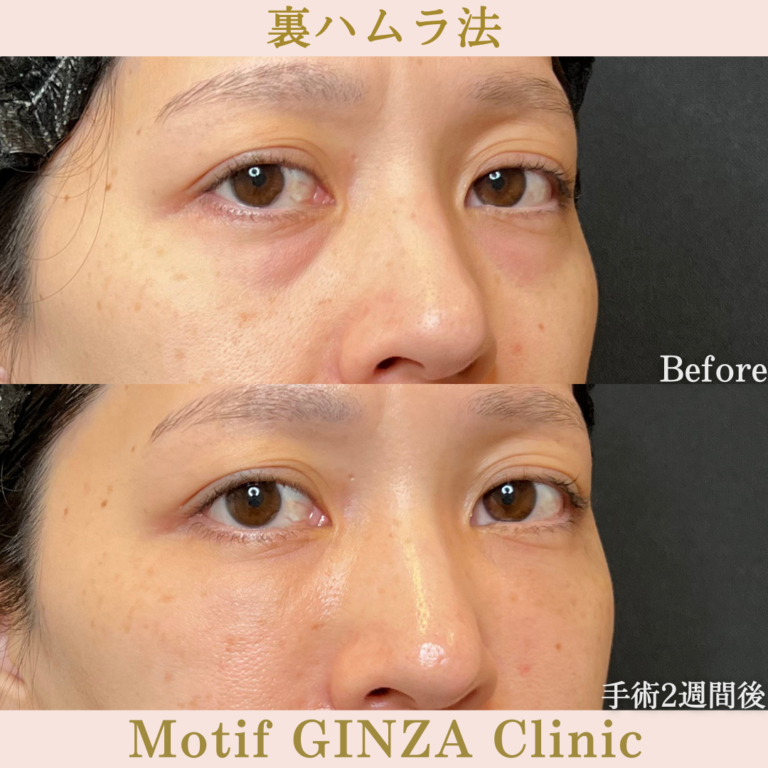 裏ハムラ法(手術1か月)の写真4