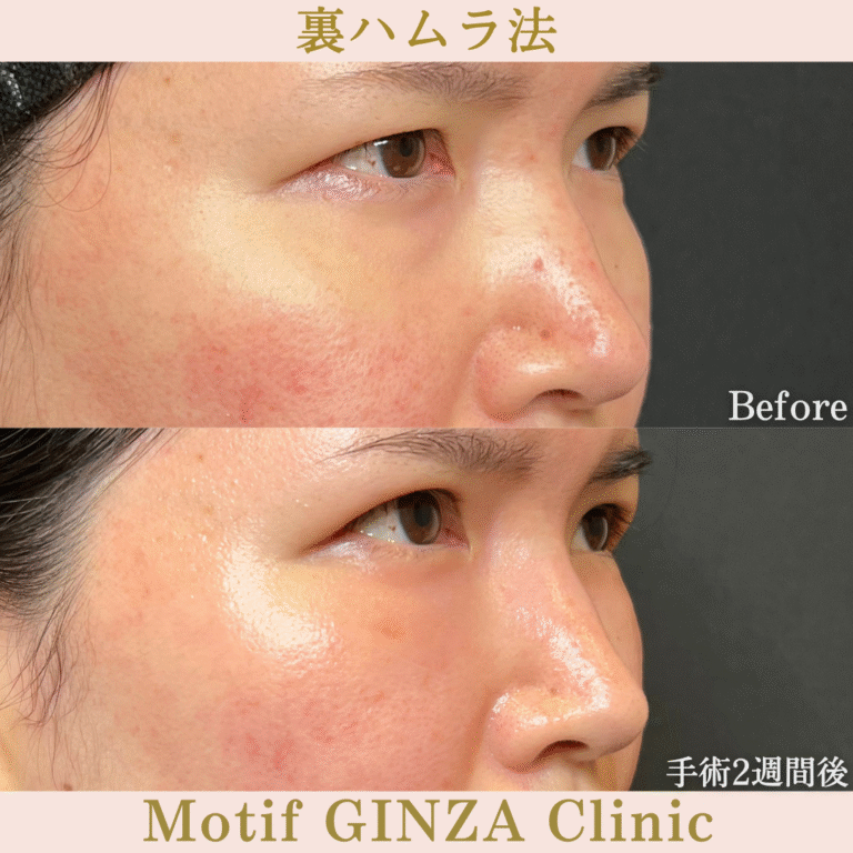 裏ハムラ法（手術３か月）の写真6