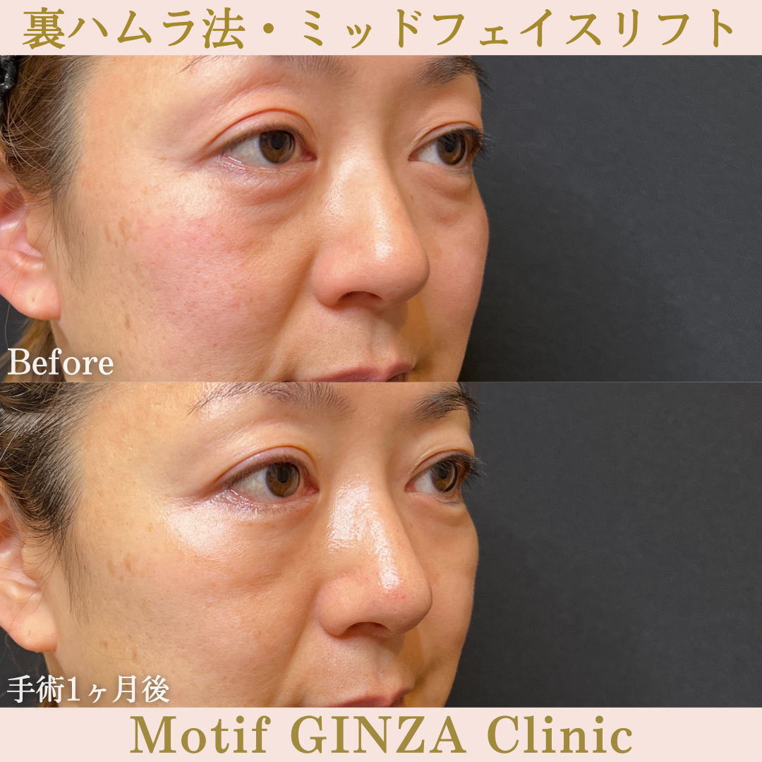 裏ハムラ法・ミッドフェイスリフト(手術6ヶ月)の写真4