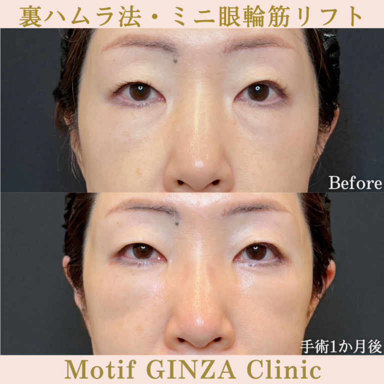 裏ハムラ法・ミニ眼輪筋リフト（手術３か月）の写真3