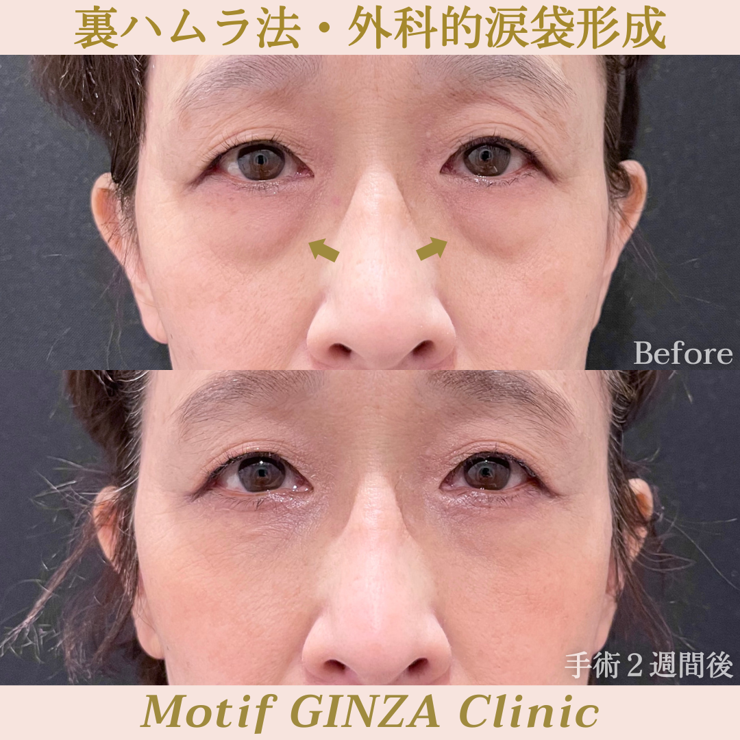 裏ハムラ法・外科的涙袋形成(手術1ヶ月)の写真3