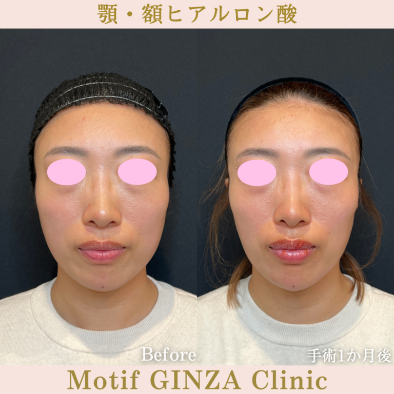 顎・額ヒアルロン酸（手術１か月）