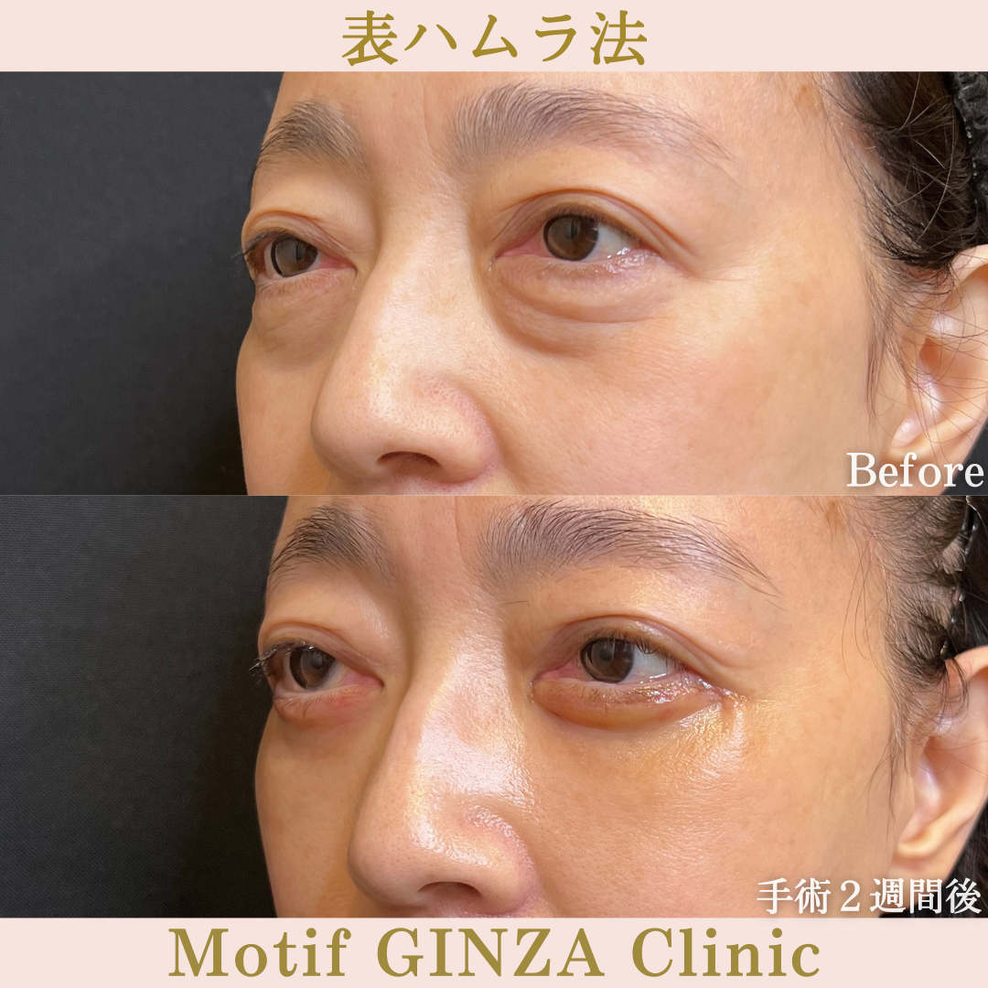 切開式下眼瞼たるみ取り（手術６ヶ月）の写真6