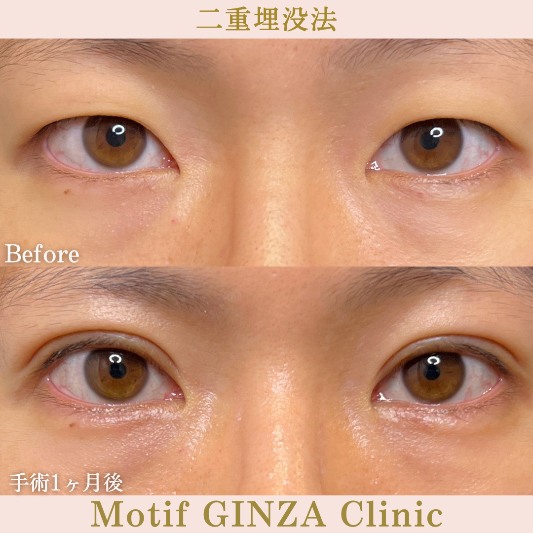 二重埋没法（手術１ヶ月）の写真