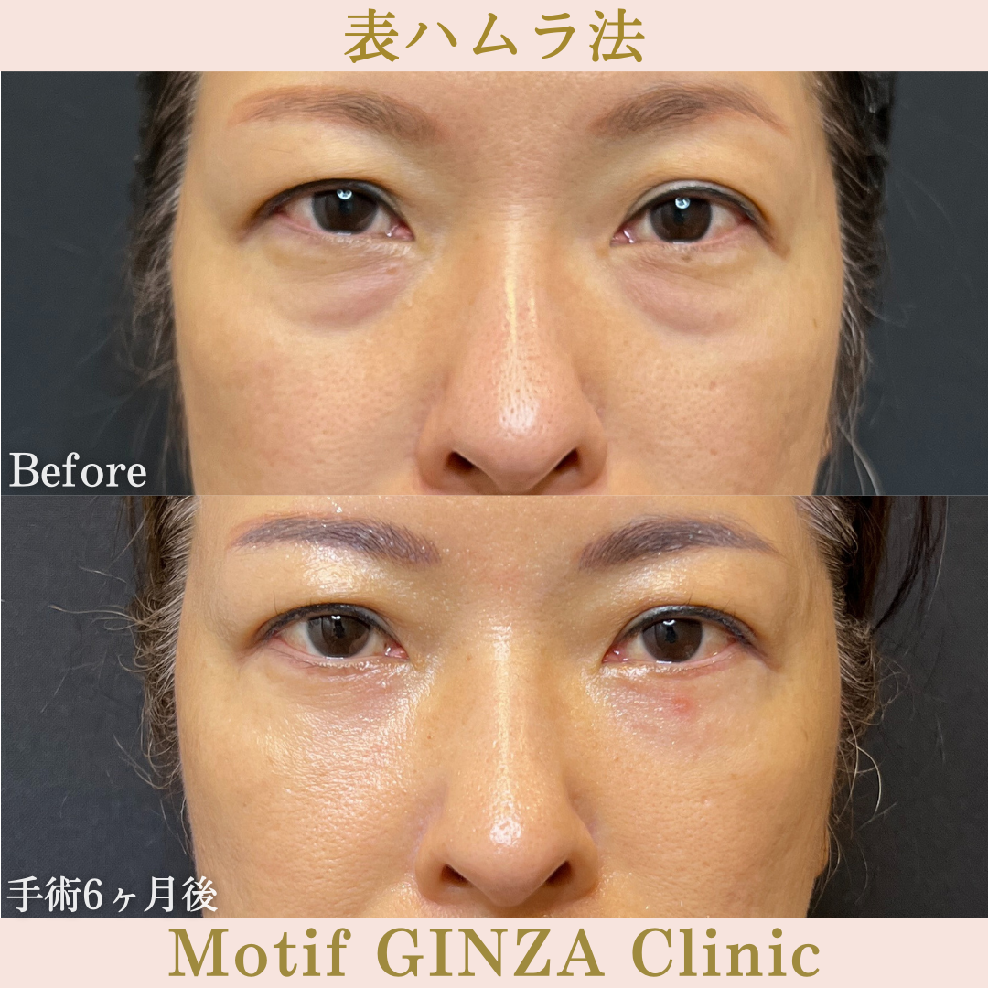切開式下眼瞼たるみ取り（手術３ヶ月）の写真