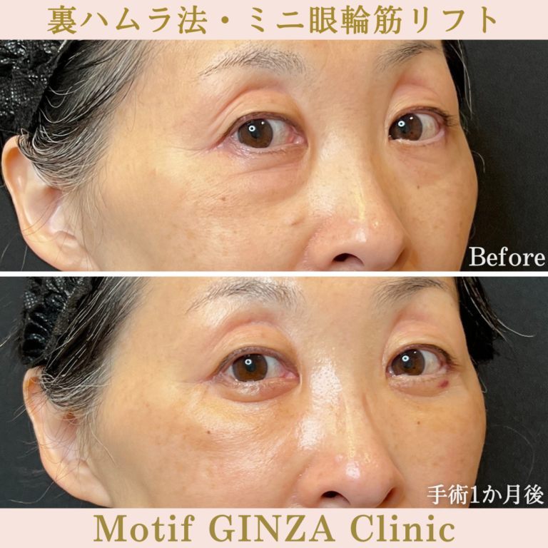 裏ハムラ法・ミニ眼輪筋リフト（手術1か月）の写真2