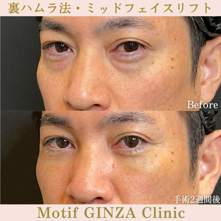 裏ハムラ法・ミッドフェイスリフト（手術1か月）の写真4