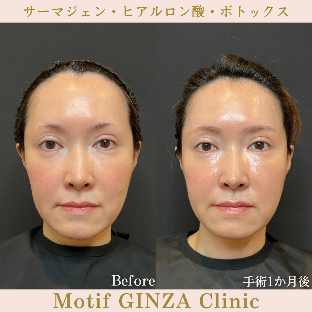 サーマジェン・ヒアルロン酸・ボトックス（手術１か月）の写真