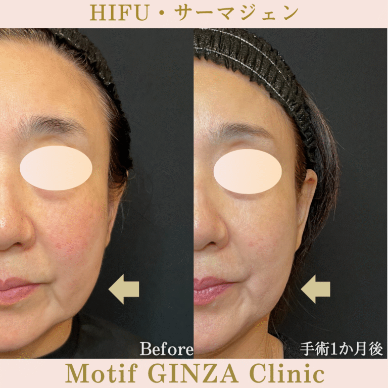 HIFU・サーマジェン（手術１か月）の写真2