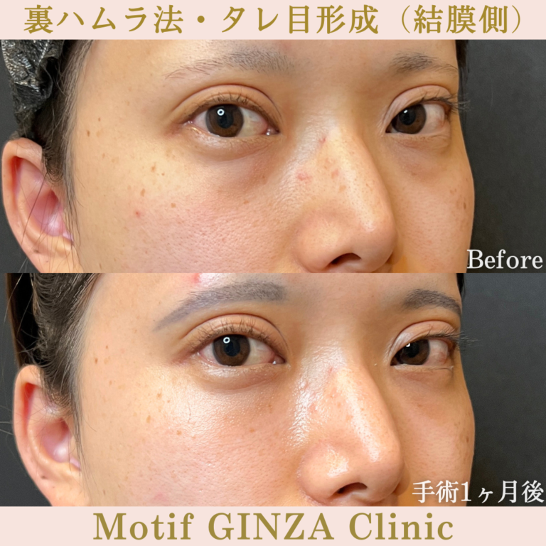 裏ハムラ法・タレ目形成（結膜側）（手術３か月）の写真4