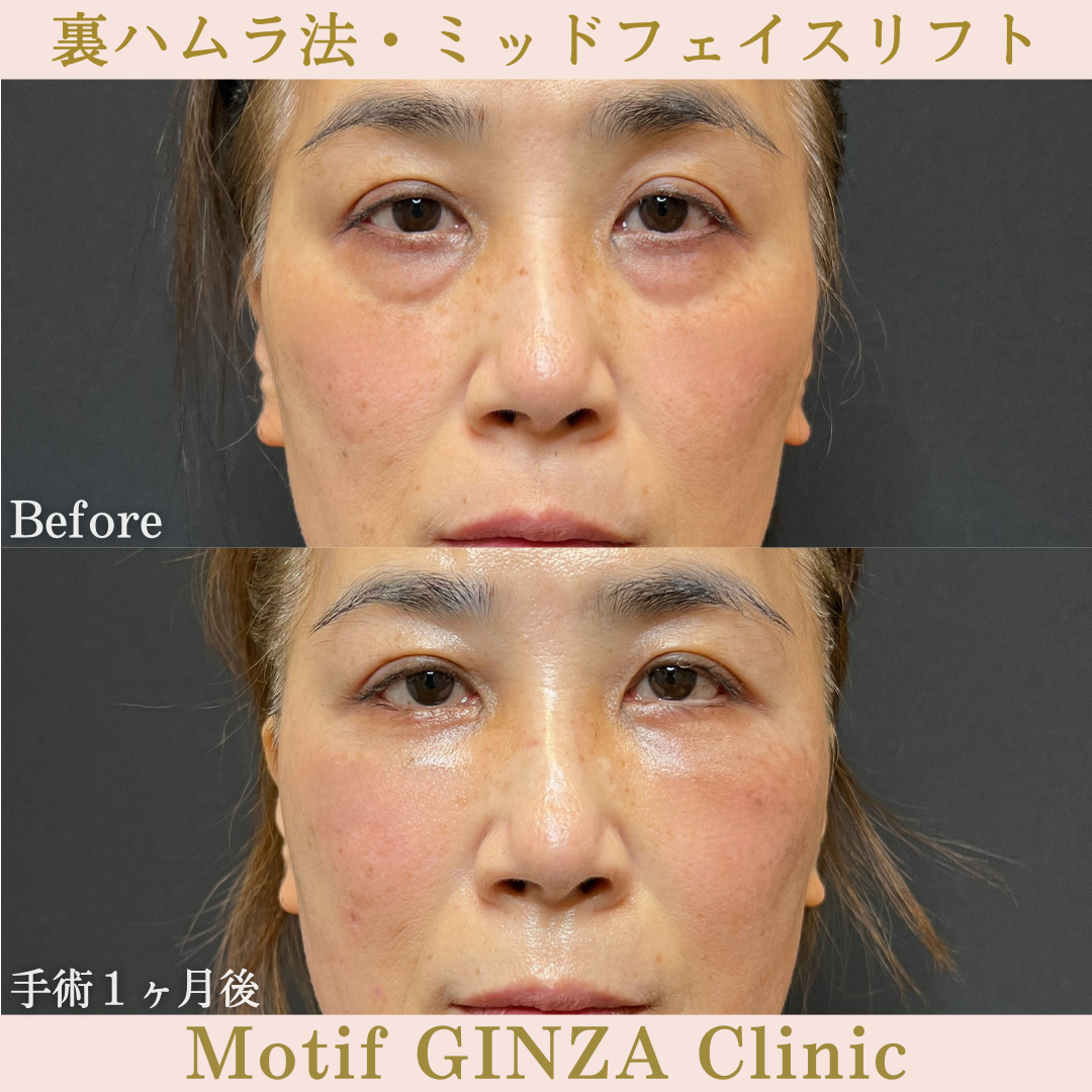 裏ハムラ法・ミッドフェイスリフト（手術3年7ヶ月）の写真5