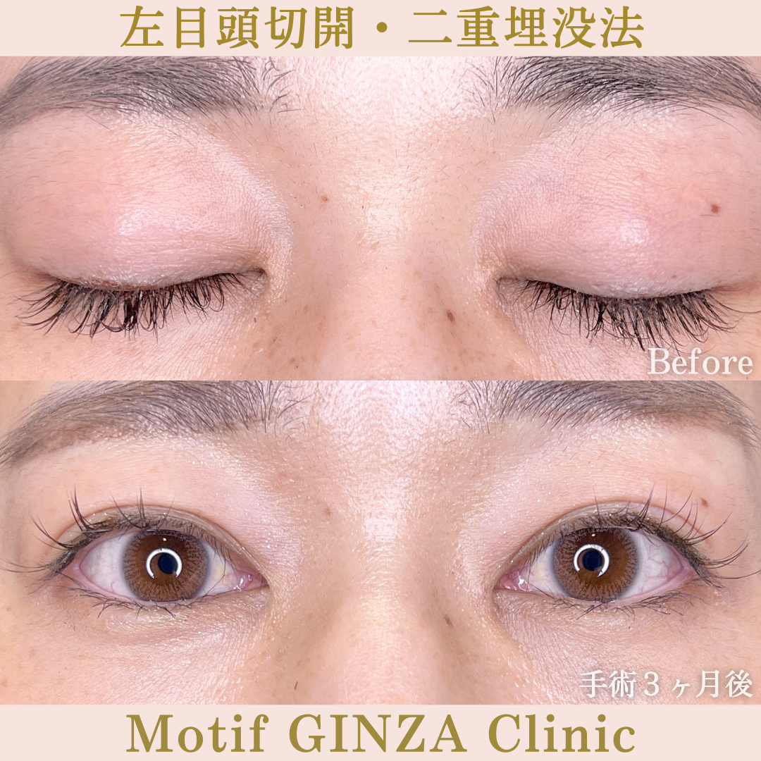 左目頭切開・二重埋没法（手術３ヶ月）の写真2