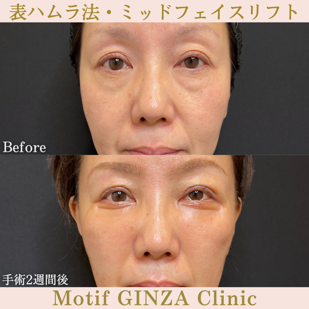 切開式下眼瞼たるみ取り・ミッドフェイスリフト(手術3ヶ月)の写真5