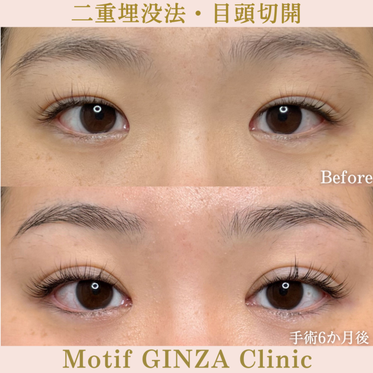 二重切開法・目頭切開（手術6か月）