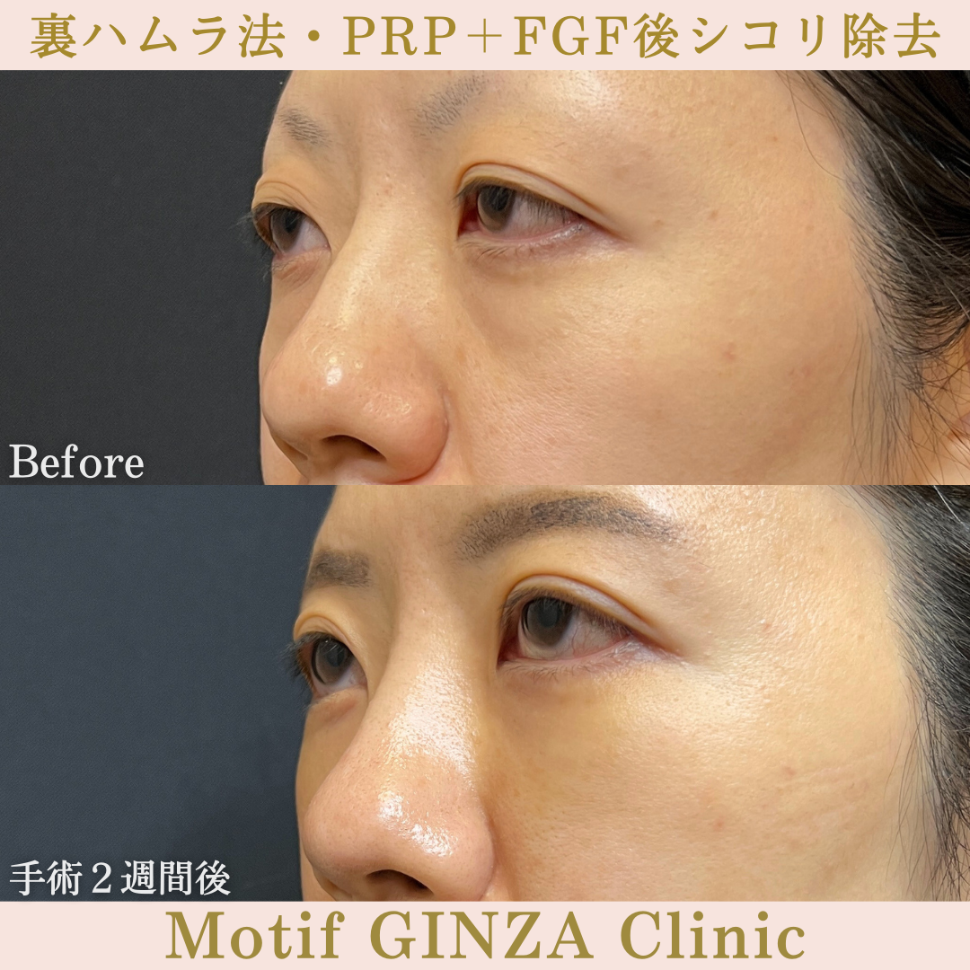 裏ハムラ法・PRP+FGF後シコリ除去(手術3ヶ月)の写真6