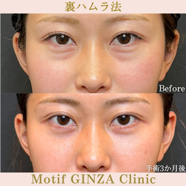 裏ハムラ法（手術3か月）