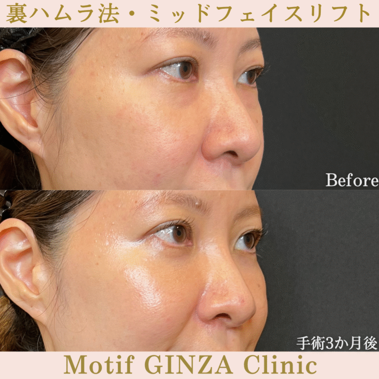 裏ハムラ法・ミッドフェイスリフト（手術３か月）の写真2