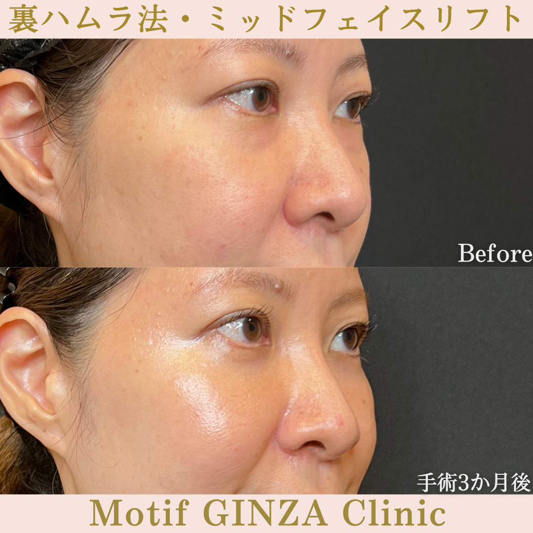 裏ハムラ法・ミッドフェイスリフト(手術6か月)の写真4