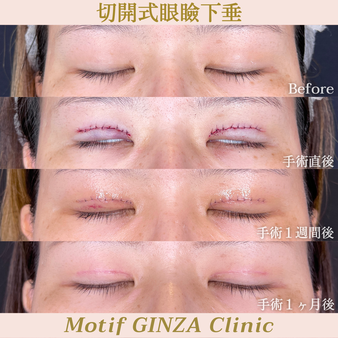 切開式眼瞼下垂手術（手術３ヶ月）の写真6