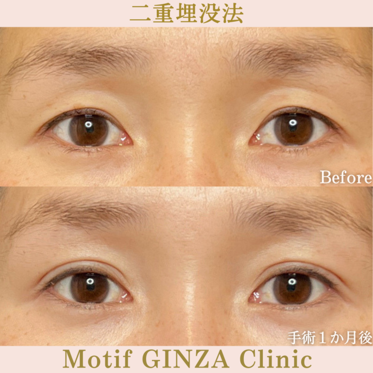 二重埋没法（手術１か月）