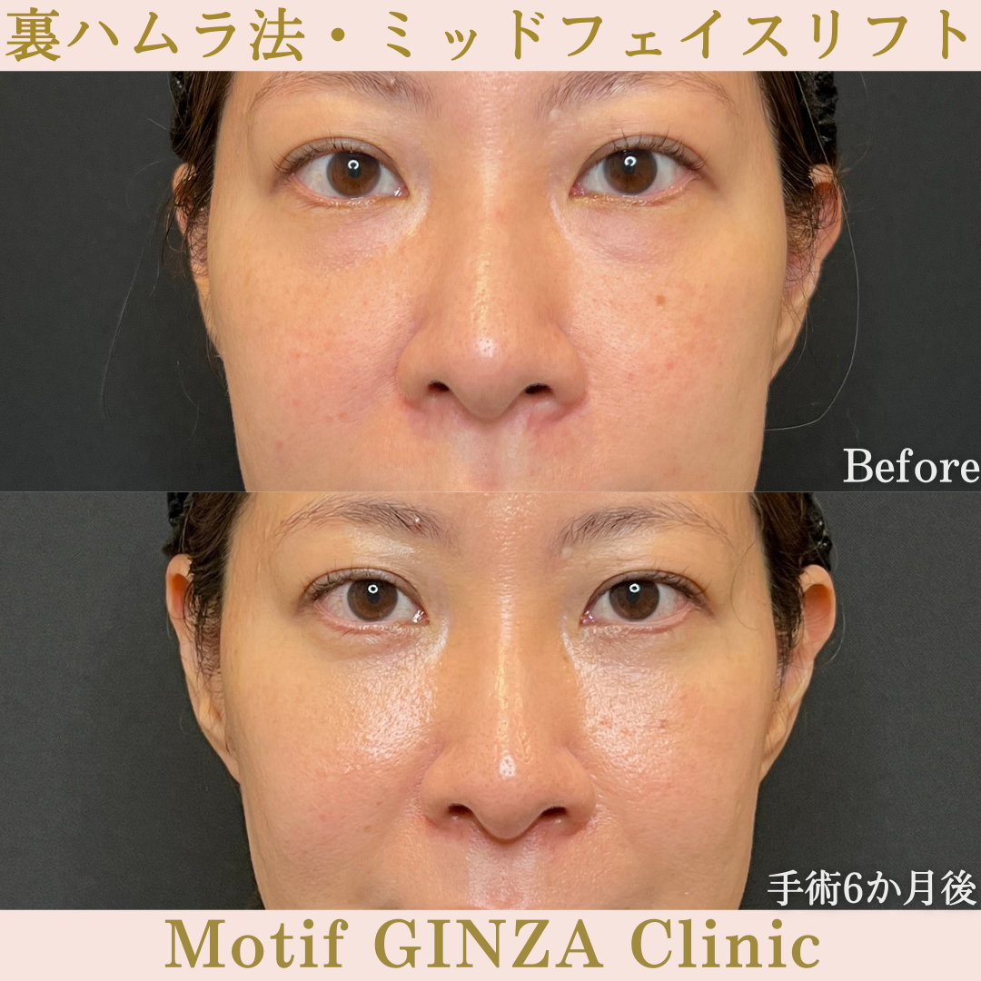 裏ハムラ法・ミッドフェイスリフト（手術6か月）の写真