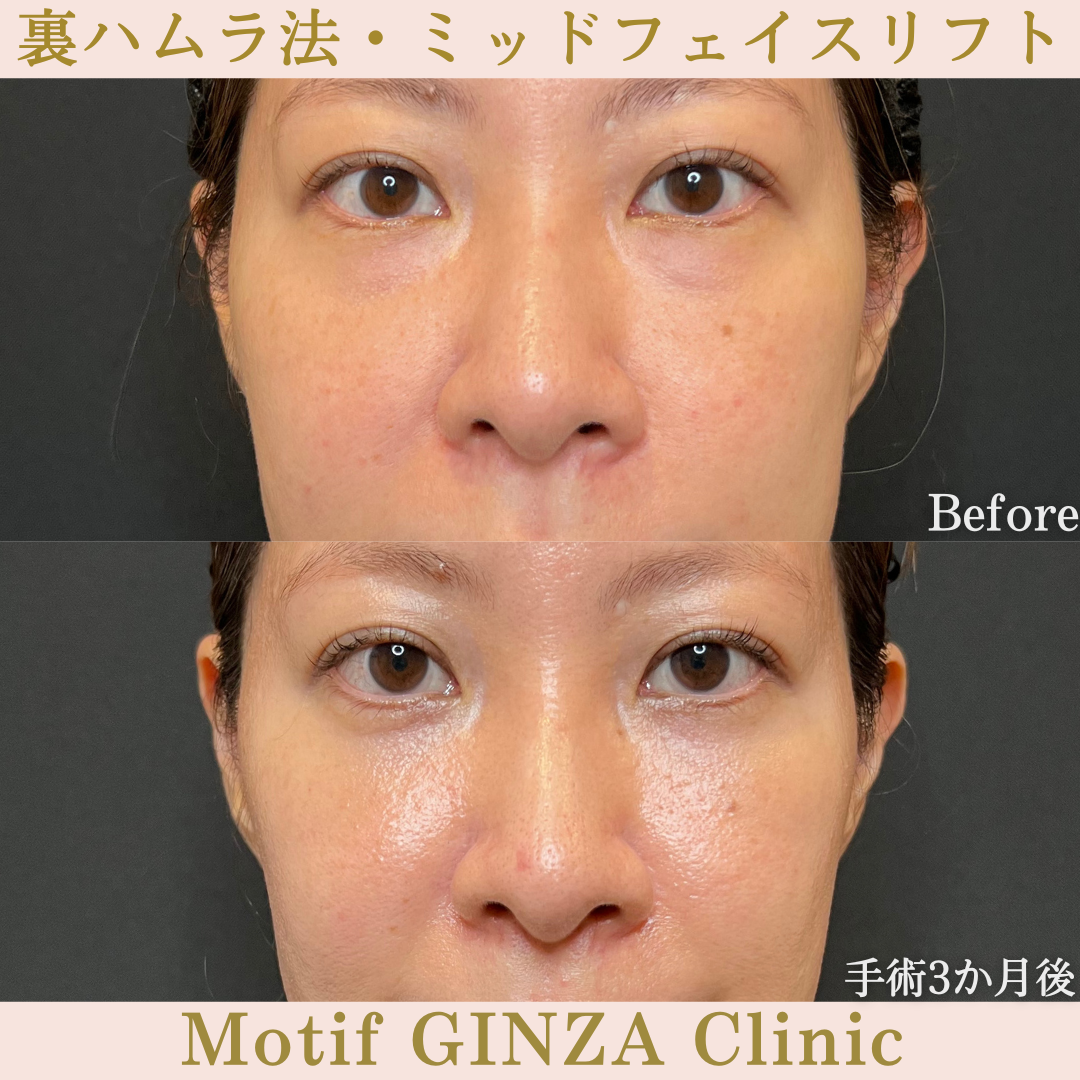 裏ハムラ法・ミッドフェイスリフト(手術6か月)の写真3