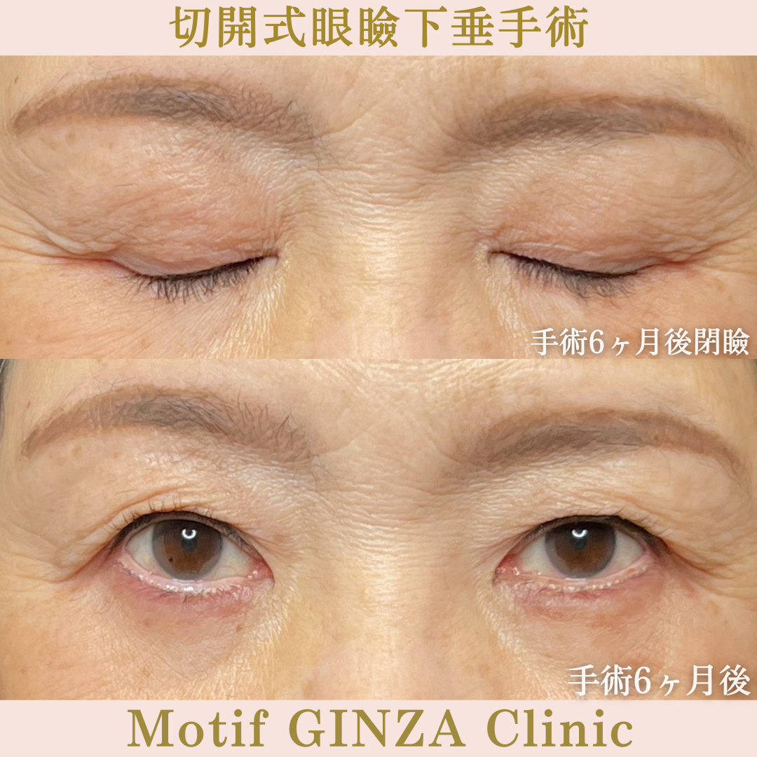 切開式眼瞼下垂手術（手術6か月）の写真2