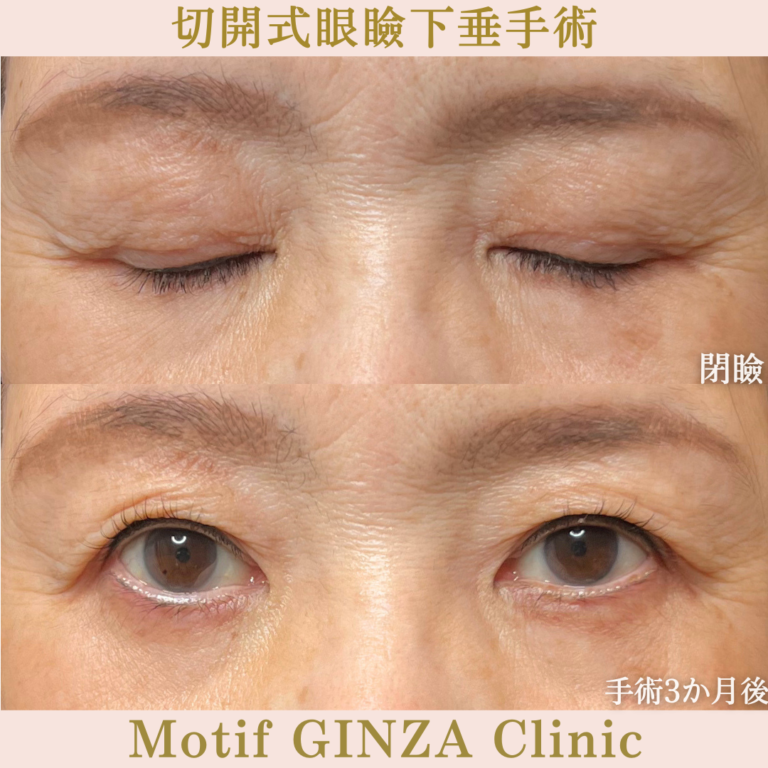 切開式眼瞼下垂手術(手術3か月)の写真2