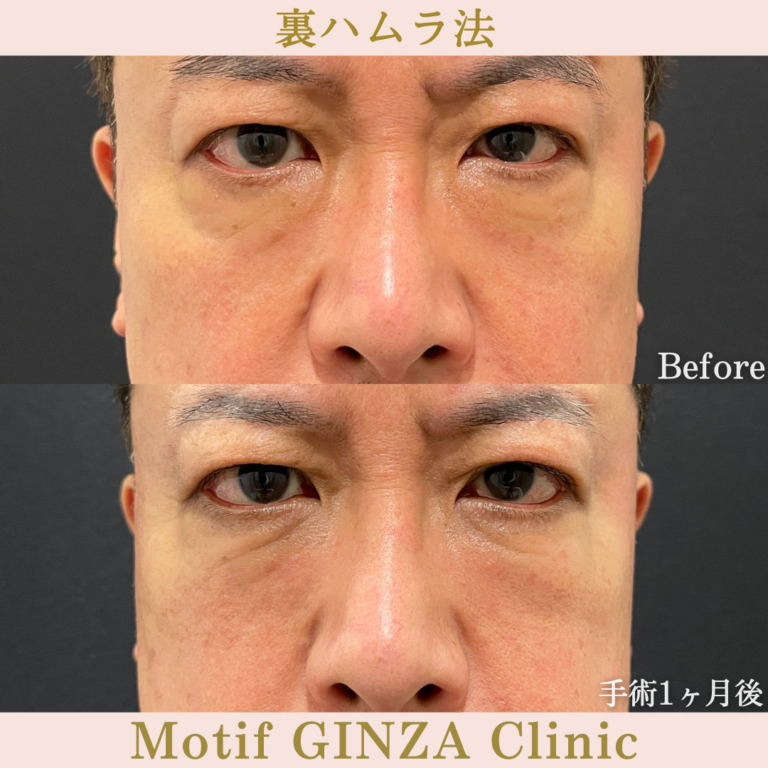 裏ハムラ法(手術3か月)の写真3