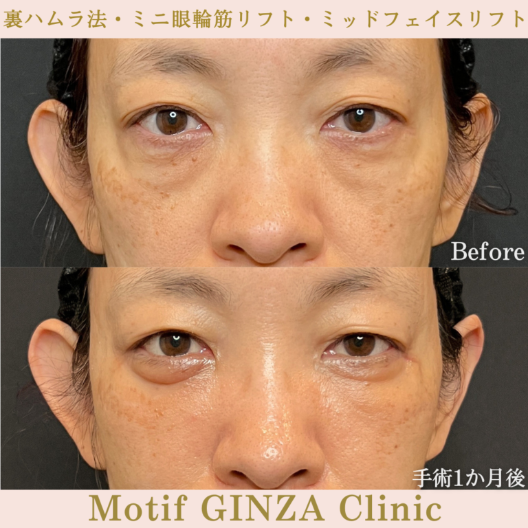 裏ハムラ法・ミニ眼輪筋リフト・ミッドフェイスリフト（手術３か月）の写真3