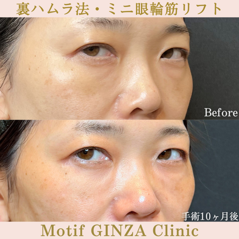 裏ハムラ法・ミニ眼輪筋リフト（手術10か月）の写真2