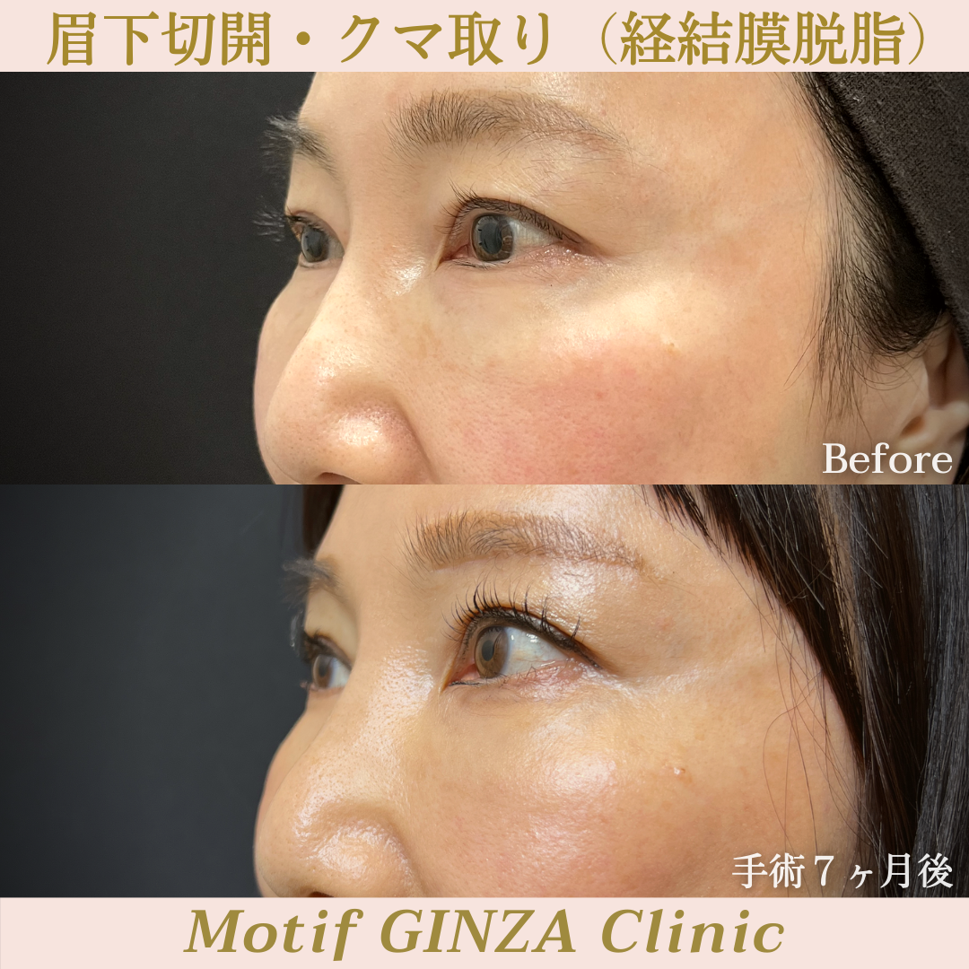 眉下切開・経結膜脱脂（手術７ヶ月）の写真2