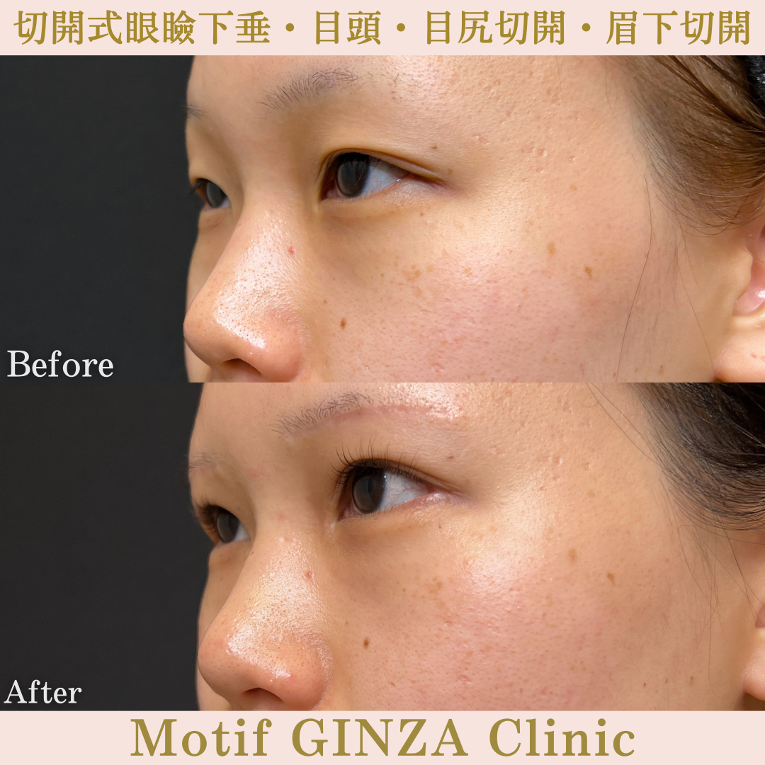 切開式眼瞼下垂・目頭切開・目尻切開・眉下切開（手術10ヶ月）の写真3