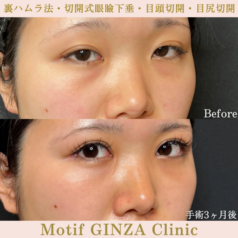 裏ハムラ法・切開式眼瞼下垂術・目頭切開・目尻切開(手術6か月)の写真5
