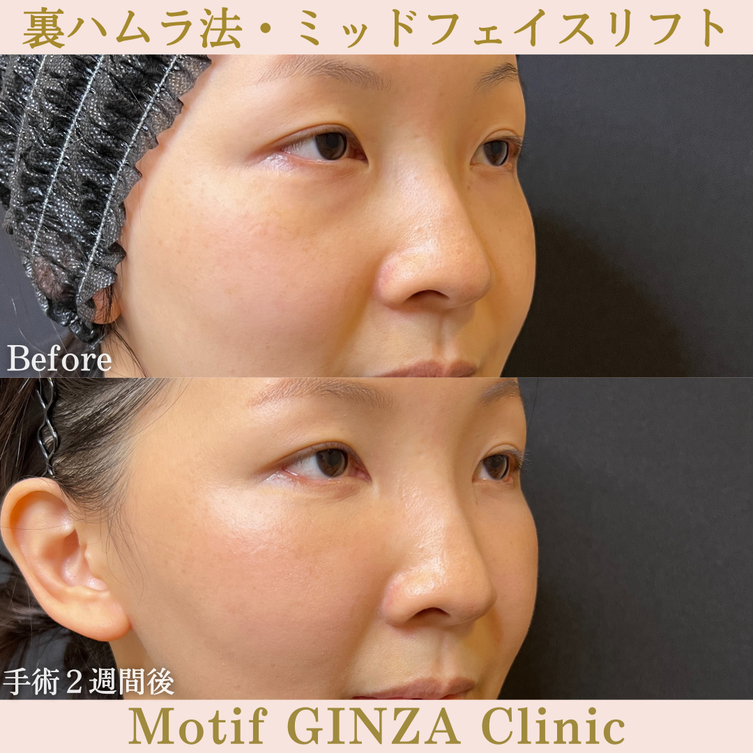 裏ハムラ法・ミッドフェイスリフト（手術３ヶ月）の写真6