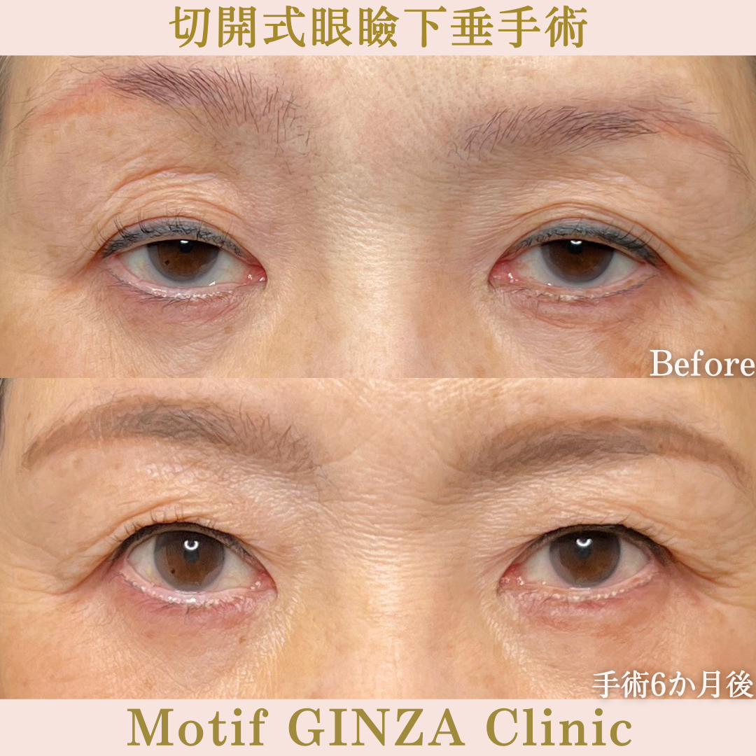 切開式眼瞼下垂手術（手術6か月）の写真