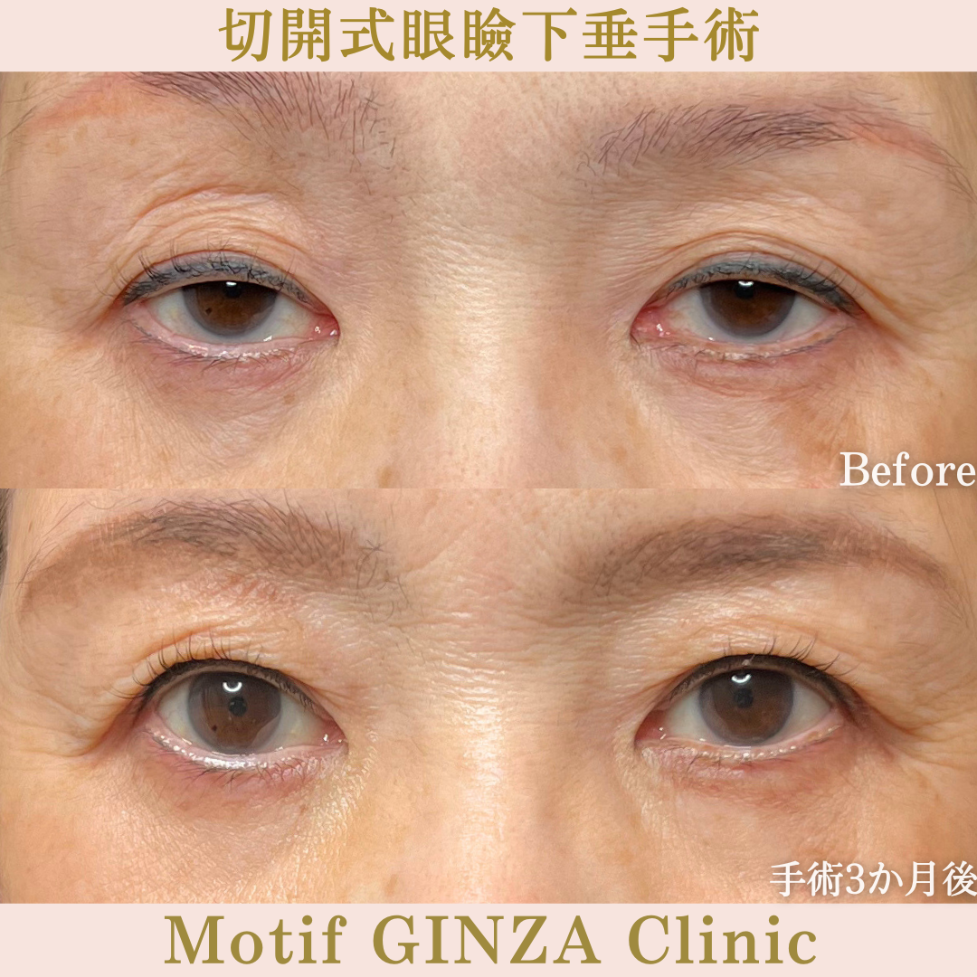 切開式眼瞼下垂手術（手術6か月）の写真3