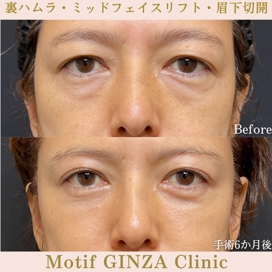 裏ハムラ法・ミッドフェイスリフト・眉下切開（手術６か月）の写真