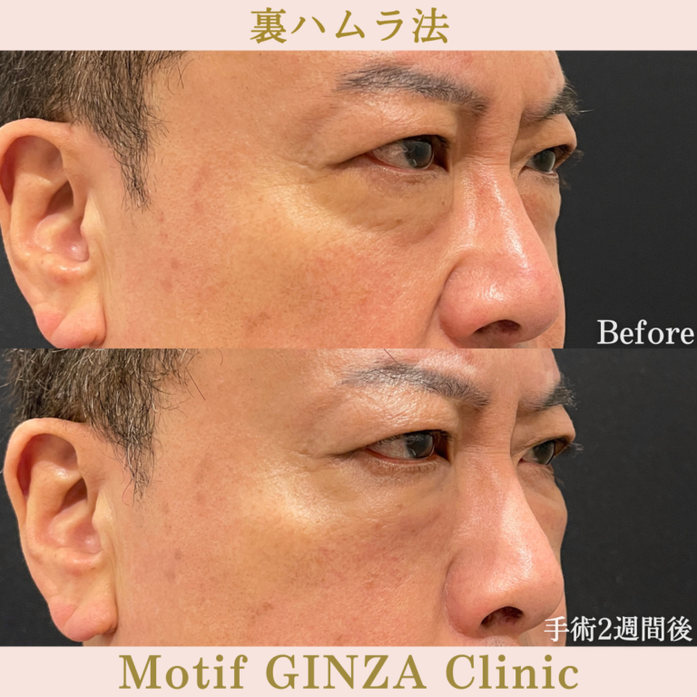 裏ハムラ法(手術3か月)の写真6