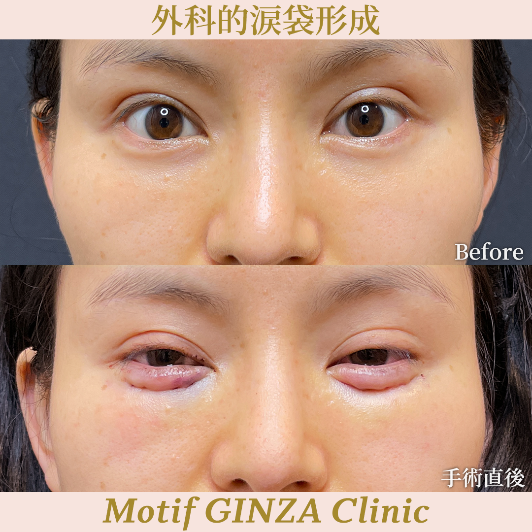 外科的涙袋形成(手術3ヶ月)の写真3
