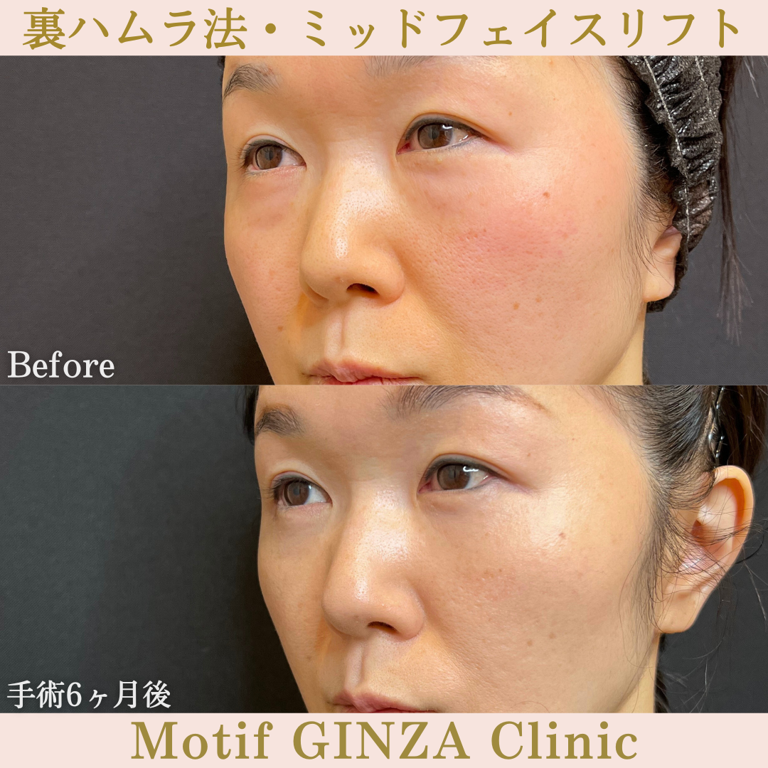 裏ハムラ法・ミッドフェイスリフト(手術6ヶ月)の写真2