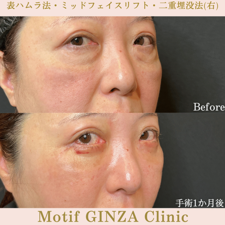 切開式下眼瞼たるみ取り・ミッドフェイスリフト・二重埋没法（手術６か月）の写真6